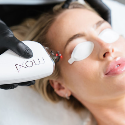 aesthetic patient getting a Moxi laser treatment 